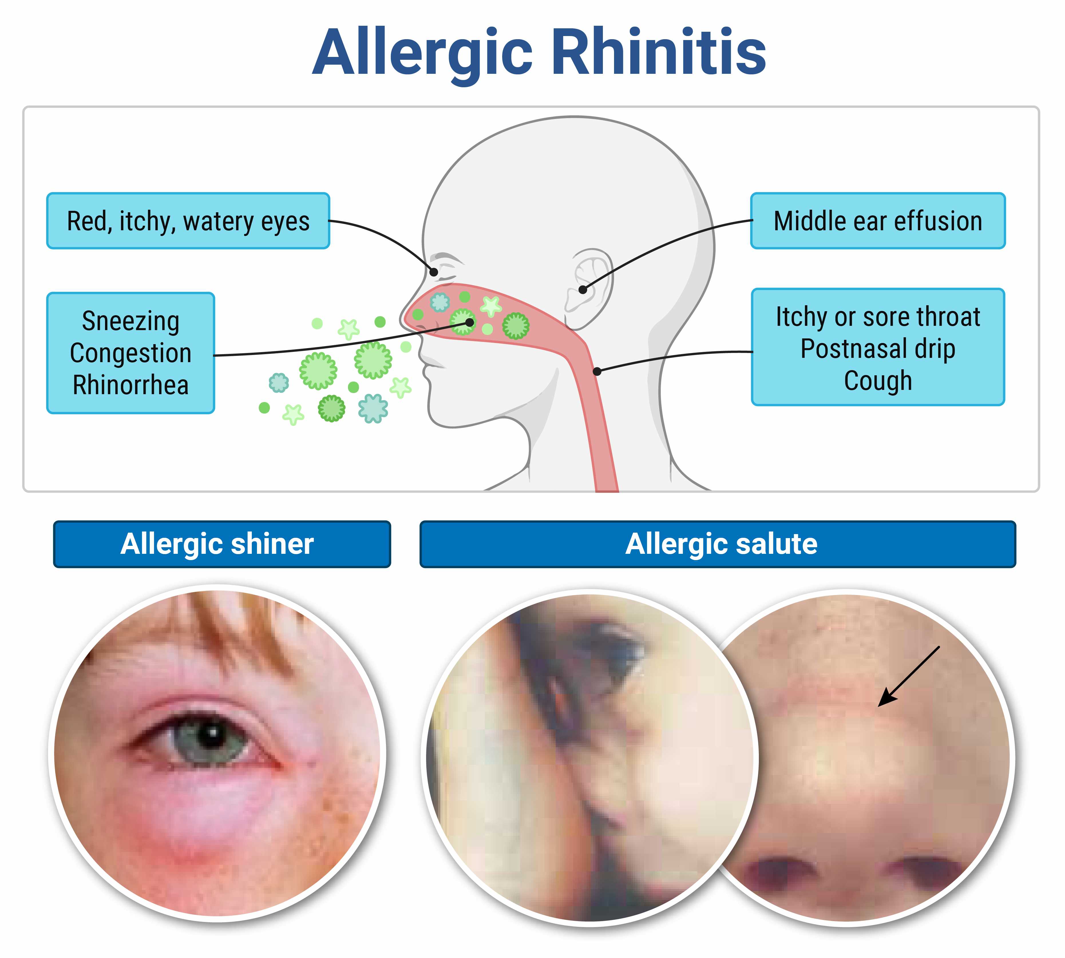 Allergic Rhinitis Osce RoshReview - SPEX Exam: Everything You Need to Know | RoshReview.com