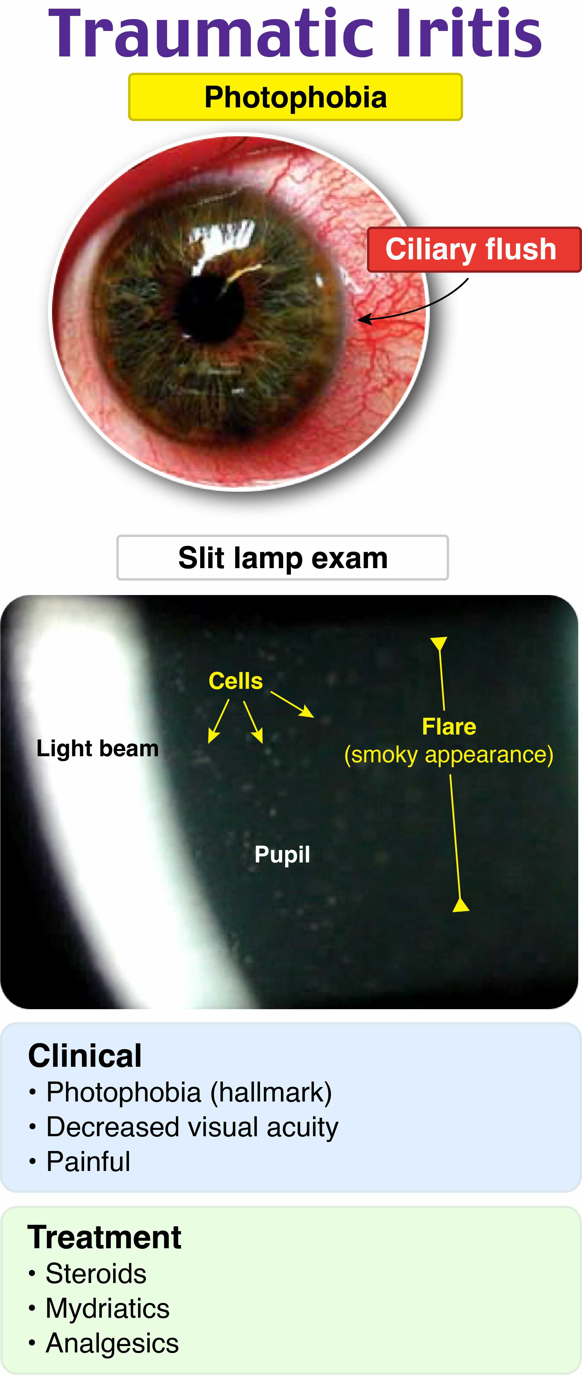 Irititis Rosh Review EM@3AM: Corneal Transplant Complications - emDocs