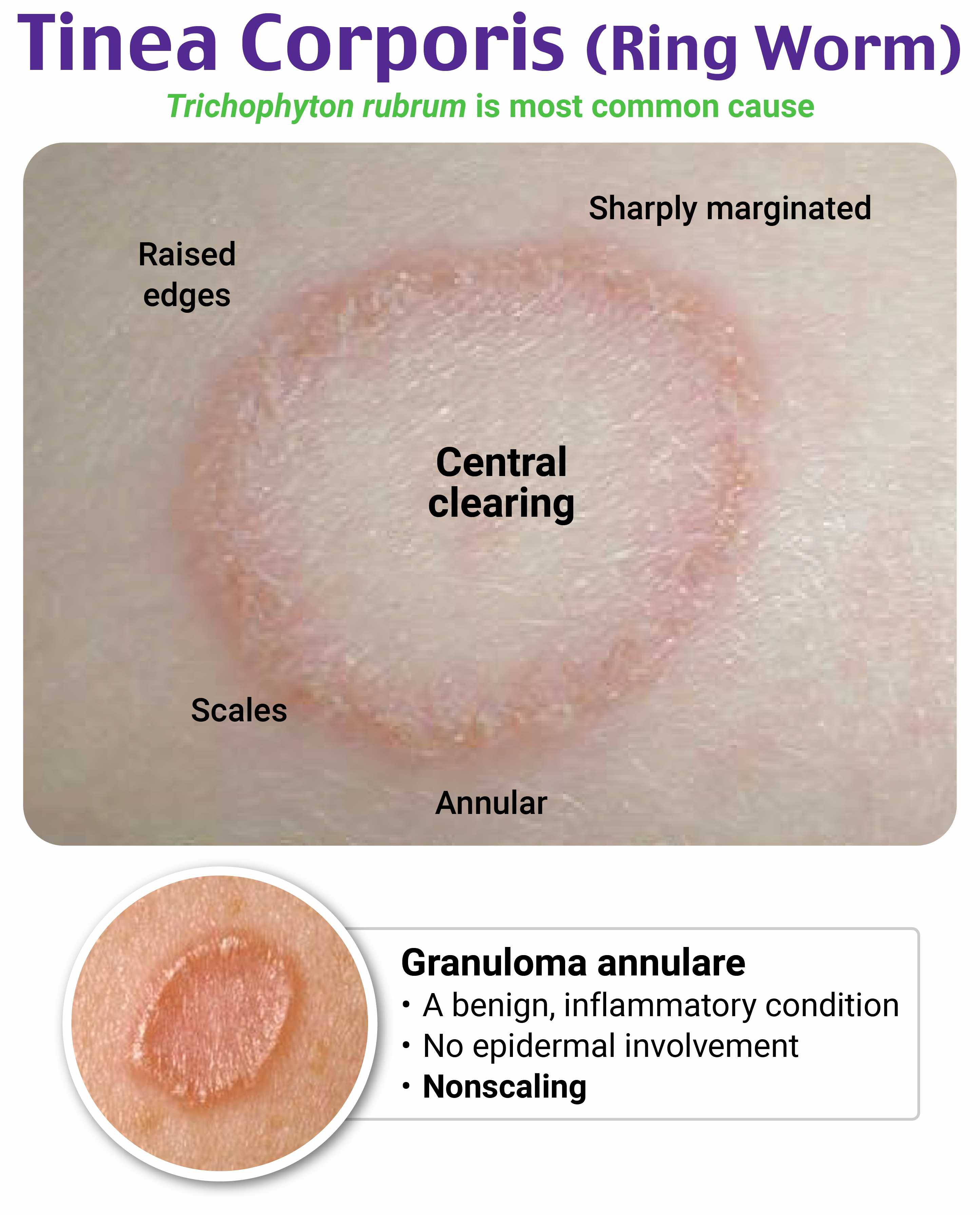 EM@3AM: Erysipelas - emDocs